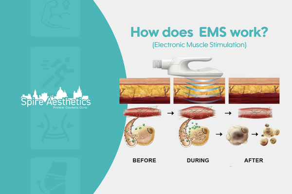 EMS treatment for post pregnancy weight loss treatment Lyme Regis