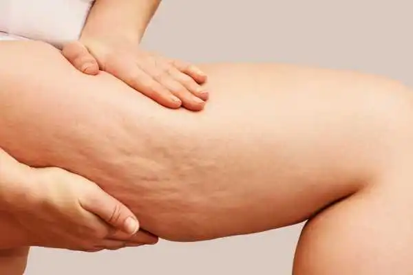 Image of woman showing leg with cellulite Lyme Regis