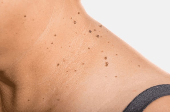 Are you looking for easy skin tag removal Lyme Regis - then contact Spire today!
