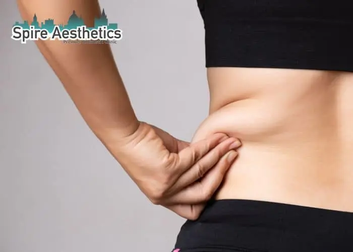 Image of woman pinching fat on their hips Lyme Regis. Fat Freezing treatment