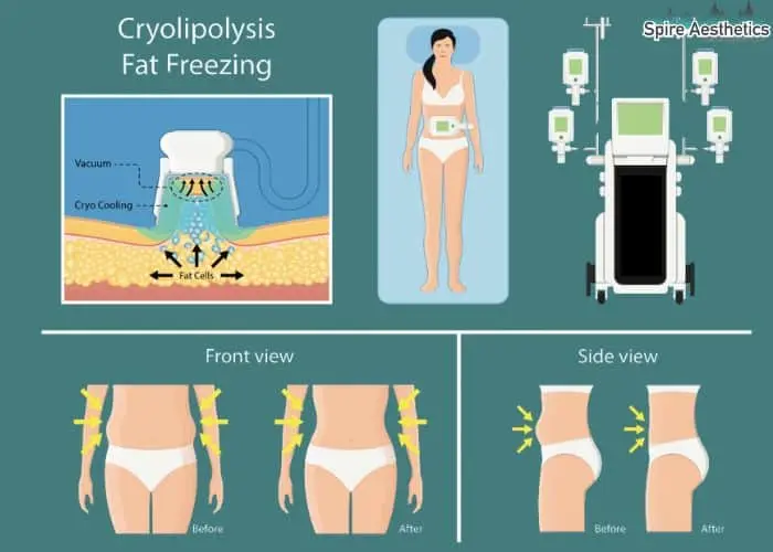 Fat freezing treatment Lyme Regis benefits for competitions to remove stubborn fat deposits.