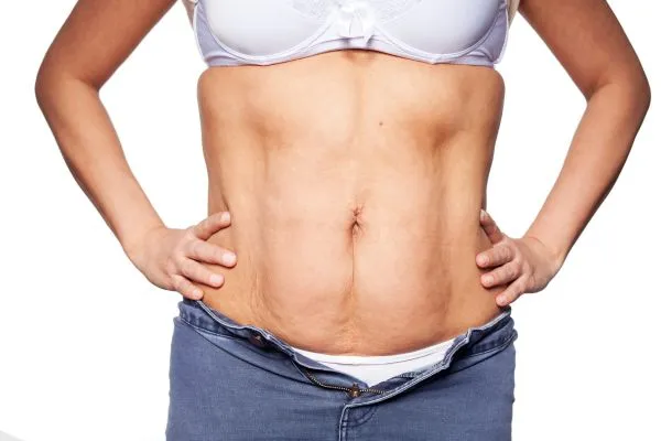 sagging skin on woman's stomach after weight loss injections Lyme Regis