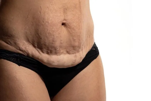 Image of womans stomach after weight loss injections Lyme Regis showing saggy skin